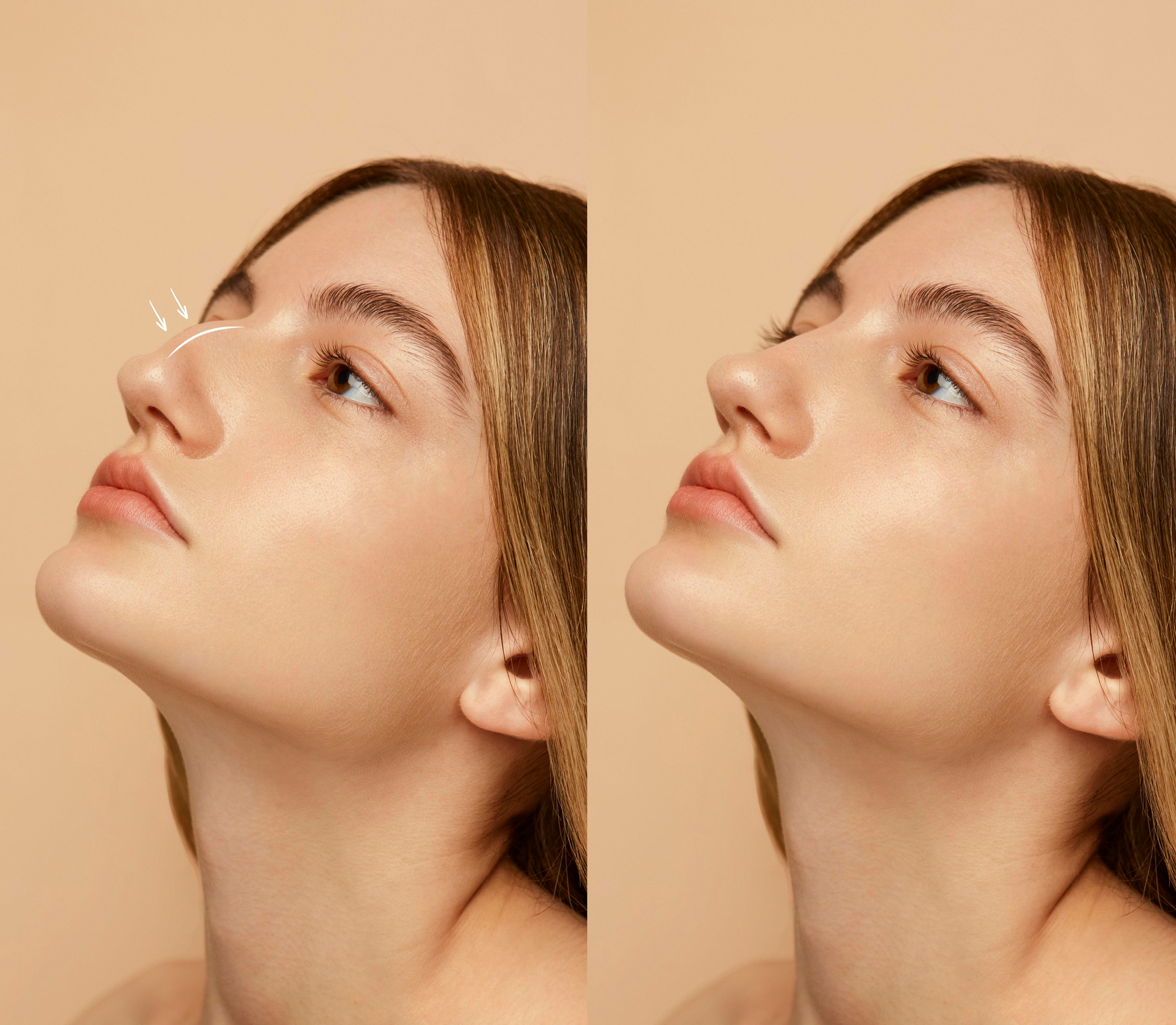 Rinoplastia: a união entre estética, função e segurança.
